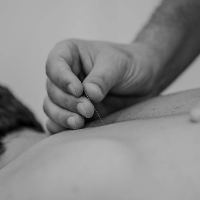 Dry Needling